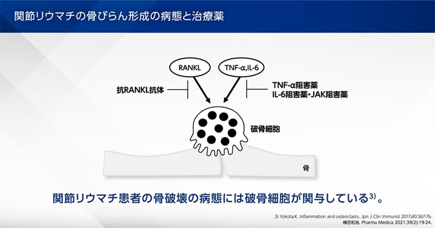 関節リウマチの骨びらん形成の病態と治療薬