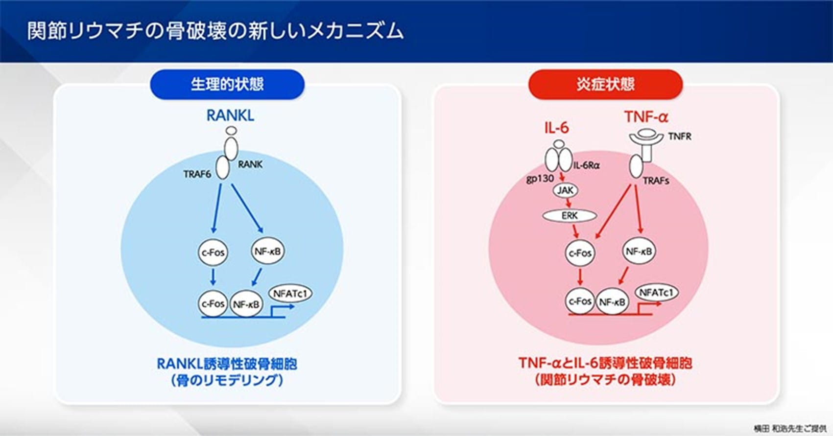 関節リウマチの骨破壊の新しいメカニズム
