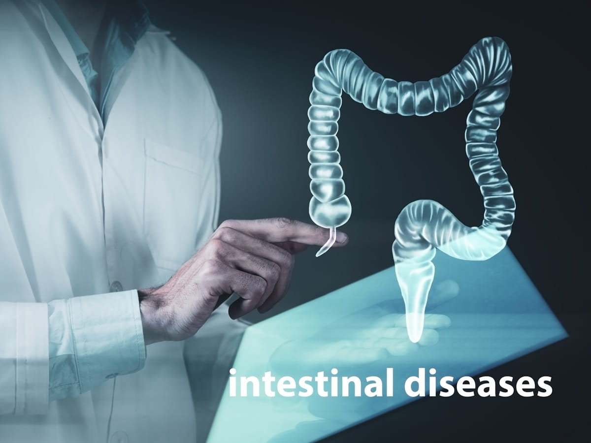 IBDにおける腸管外合併症に関連する要因が新たに特定される